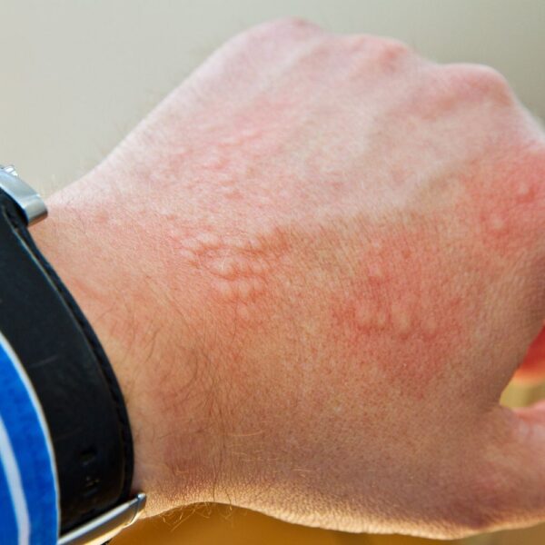 What are the Causes and Treatment Options for Hives? 