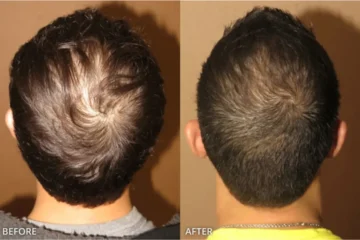 Hair Transplantation in Colombia