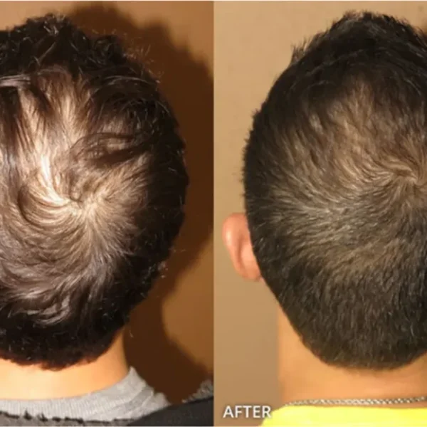 Hair Transplantation in Colombia