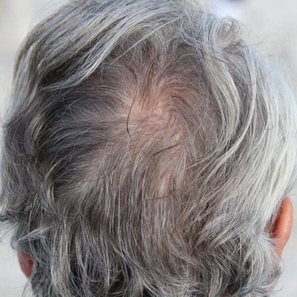 Can Stem Cells Become the Holy Grail for Hair Loss?