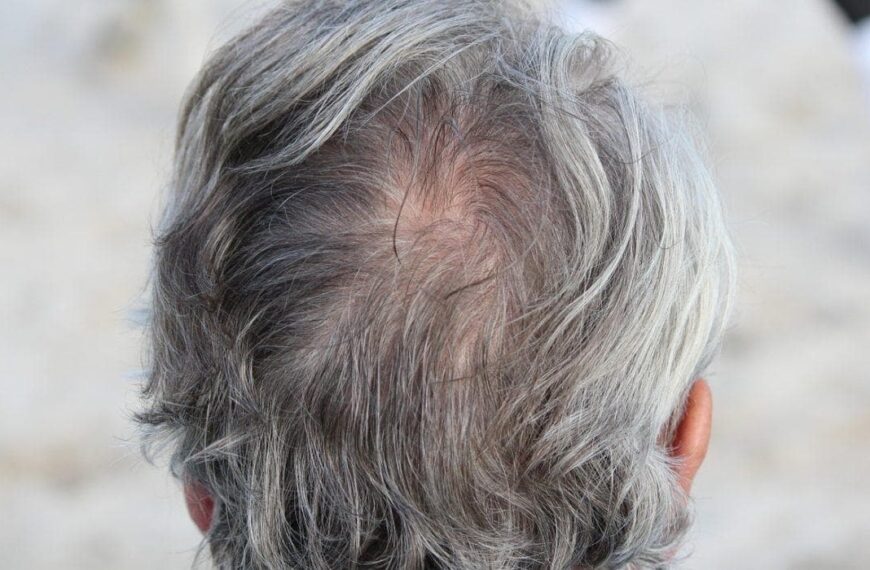 Can Stem Cells Become the Holy Grail for Hair Loss?