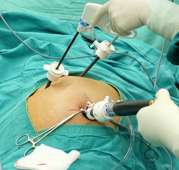 Gallbladder Surgery/Removal in Singapore | Costs & Procedure