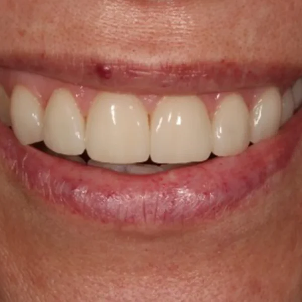 Transform Your Smile Today Discover Top Cosmetic Dentistry Options in Wirral 