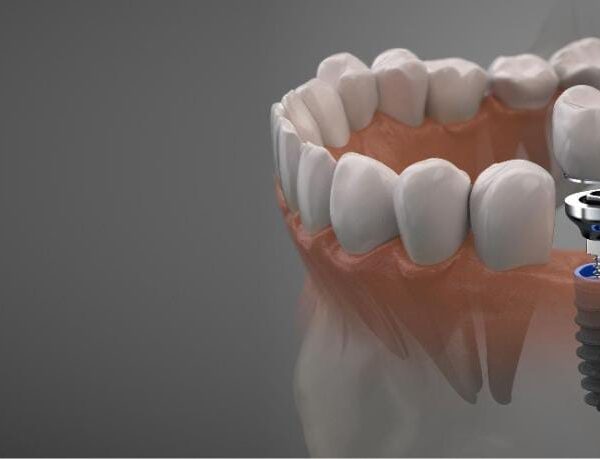 What Should You Know Before Getting Dental Implants?