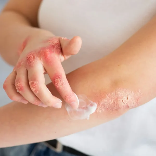 How is the use of remedies and Ayurvedic herbs for eczema useful