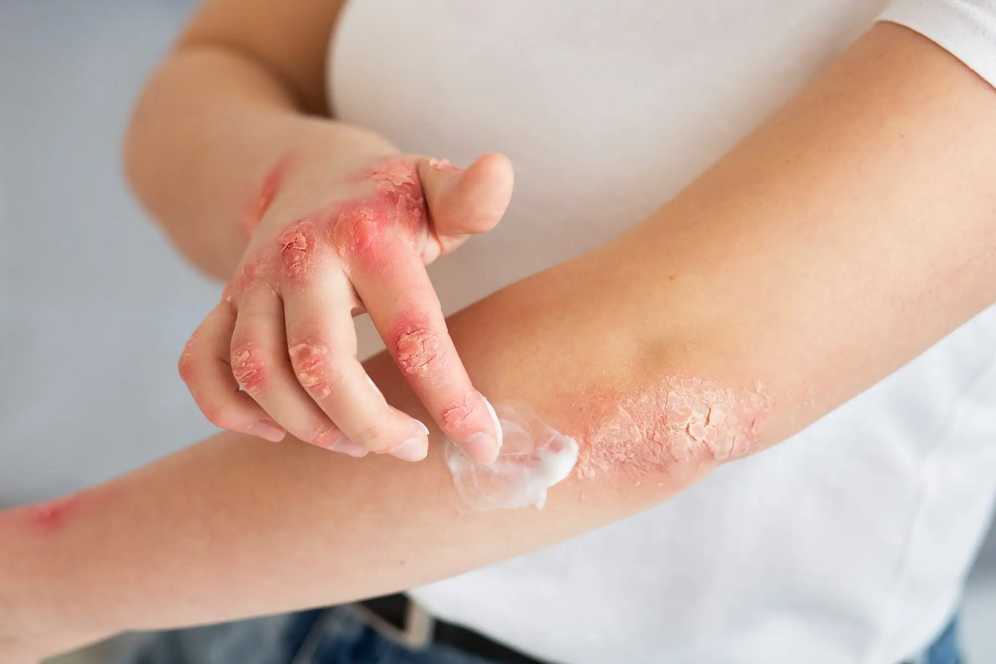 How is the use of remedies and Ayurvedic herbs for eczema useful