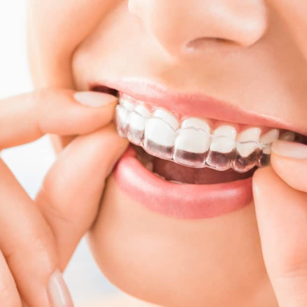 The Ultimate Guide To Transparent Aligners: Everything You Need To Know