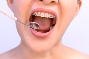 Navigating The Long-Term Benefits Of Dental Braces For Adults