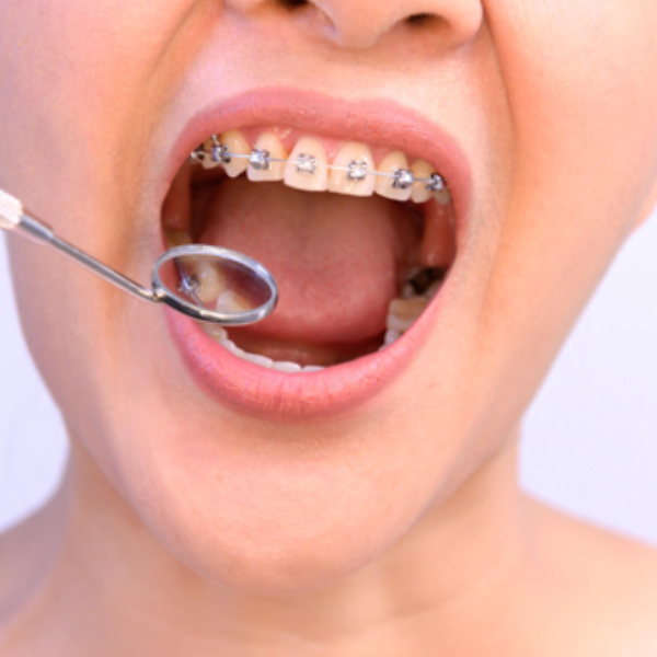 Navigating The Long-Term Benefits Of Dental Braces For Adults