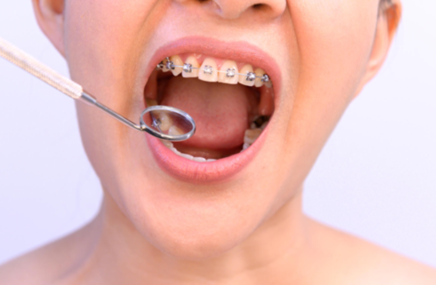 Navigating The Long-Term Benefits Of Dental Braces For Adults